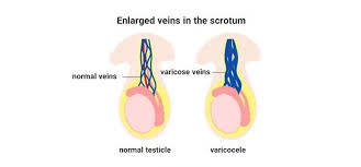 Varicocele Treatment